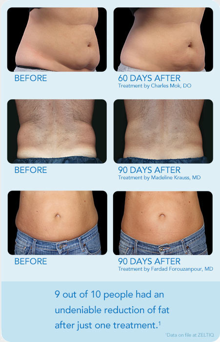 Before and after Coolsculpting treatment