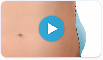 Watch a video on how Coolsculpting works...