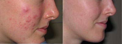 Steroid injection for acne treatment