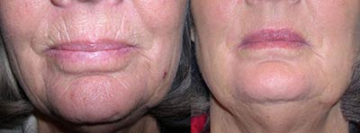Before and after Fraxel Re:pair® Fractional Laser Resurfacing