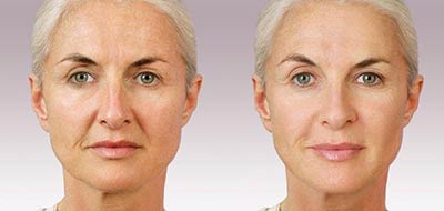 Before and after treatment with Juvederm®