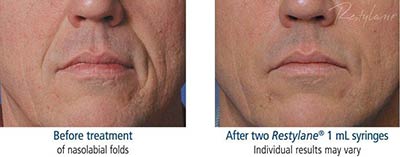 Before and after treatment with Restylane®