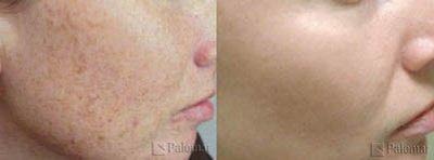 Before and after treatment with the Palomar Lux Pulsed Light System®