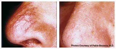 Before and after Rosacea treated with the V Beam® laser