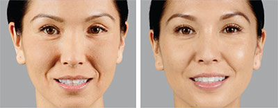 Before and after treatment with Juvederm Voluma® XC