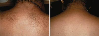 Before and after LightSheer® Laser Permanent Hair Reduction
