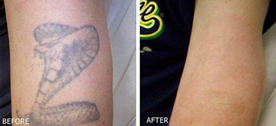 Tattoo removal with MedLite® Laser